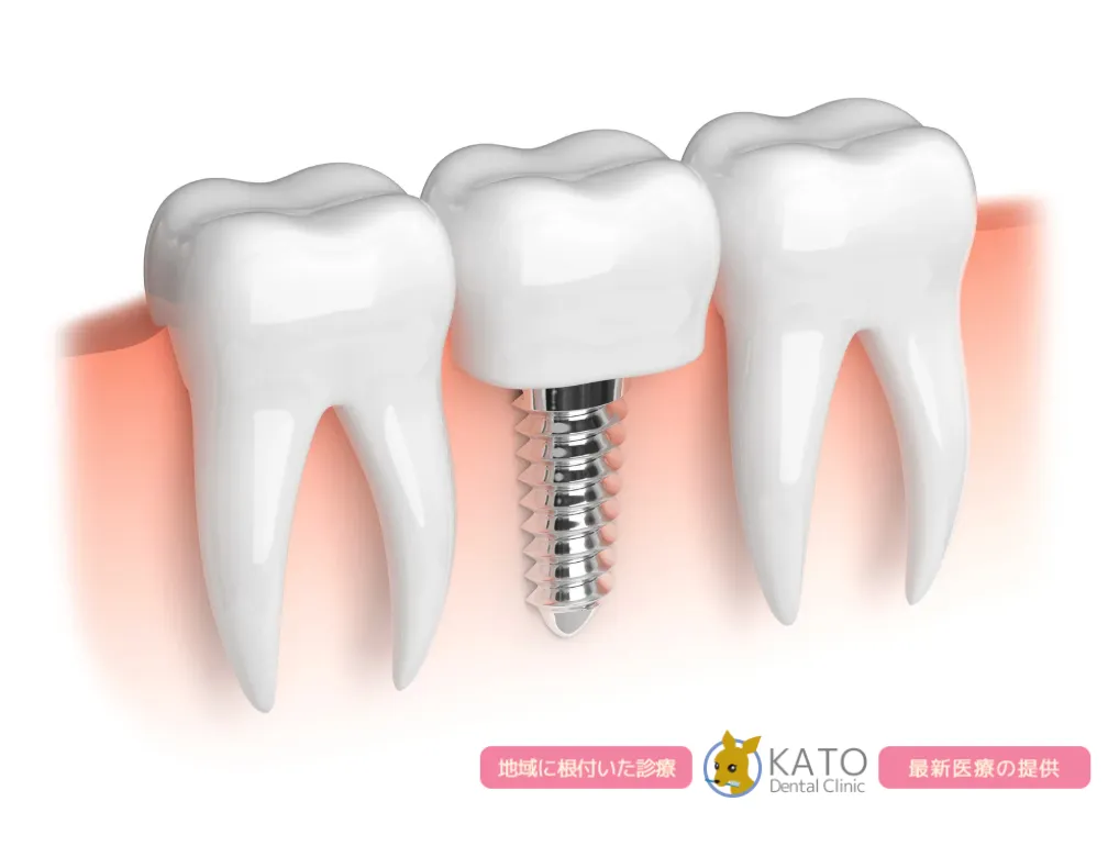 インプラントのメンテナンスが重要な理由~長持ちさせる7つのポイント~
