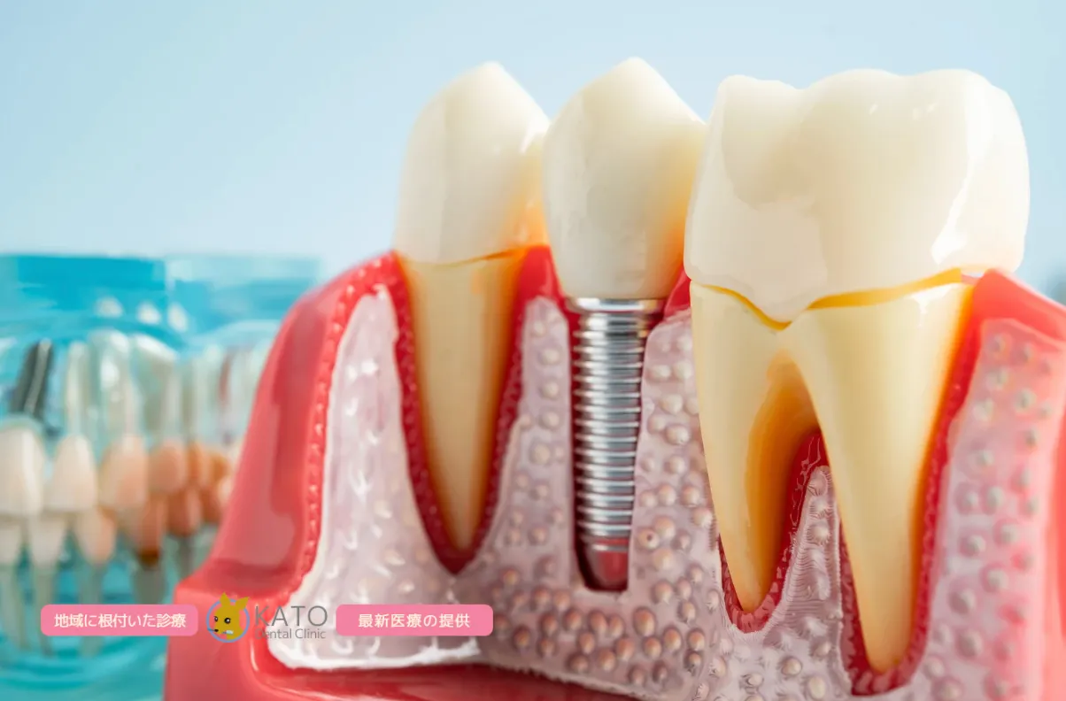埼玉で選ばれるインプラント治療の口コミと選び方