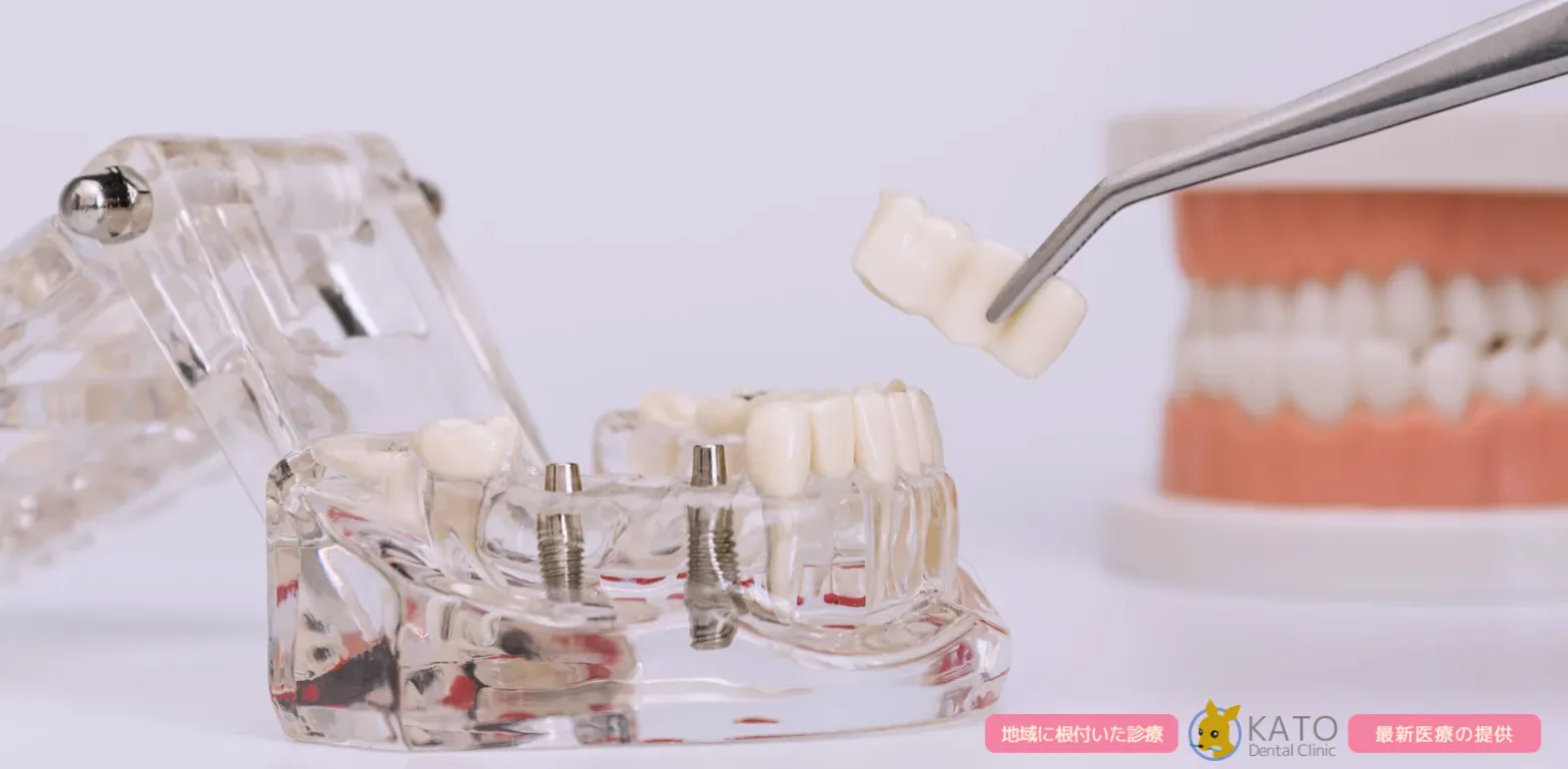 鴻巣市の歯科でインプラント治療を選ぶ前に知っておきたい基礎知識と選び方
